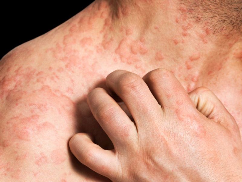 News Picture: 1 in 10 Will Develop Eczema in Their Lifetime