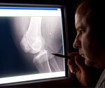 Osteoporosis:Are Your Bones at Risk?