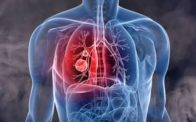 Blood cell insights offer potential boost to lung cancer therapies