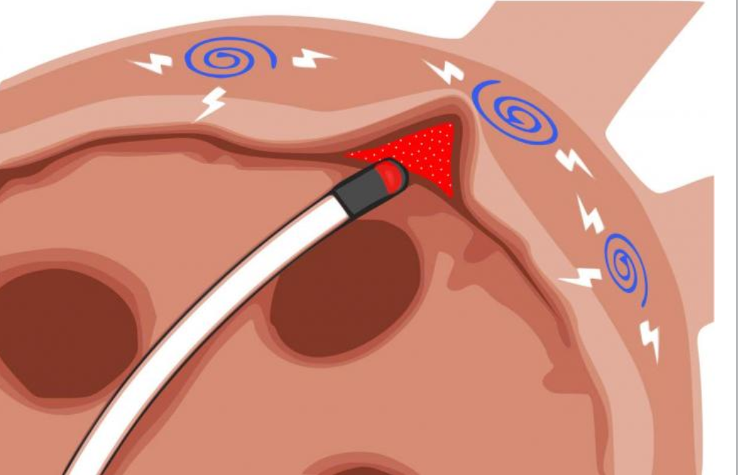 irregular-heartbeat-treatments-menopause-now