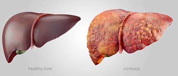 Resistant starch supplement reduces liver triglycerides in people with fatty liver disease