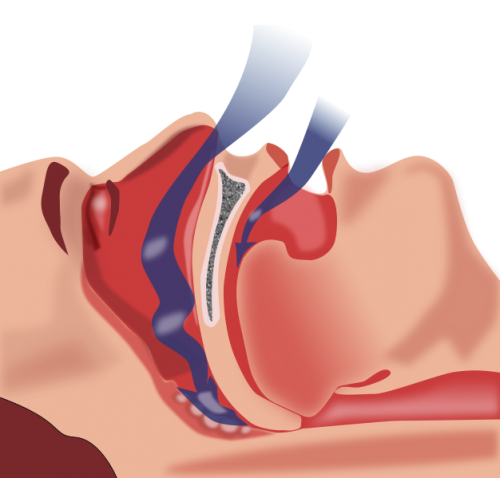 Study explains link to increased cardiovascular risks for people with obstructive sleep apnea