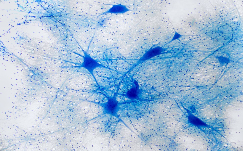'New' ALS gene destabilizes neuron's structure and chokes off its nucleus